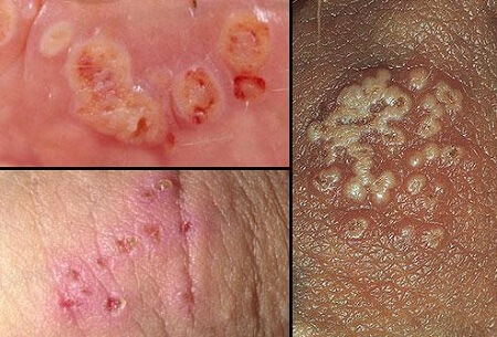 Ảnh bệnh Lậu ở nam và nữ giới Ảnh bệnh Lậu ở nam và nữ giới