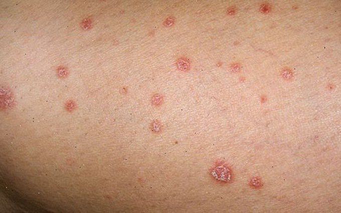 Bác sĩ đang xem tình trạng của nam sinh 19 tuổi Bệnh Lậu là một căn bệnh nguy hiểm