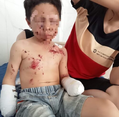 Bé trai bị cut 2 tay và nhiều vết thương khác trên người Bé trai bị cut 2 tay và nhiều vết thương khác trên người