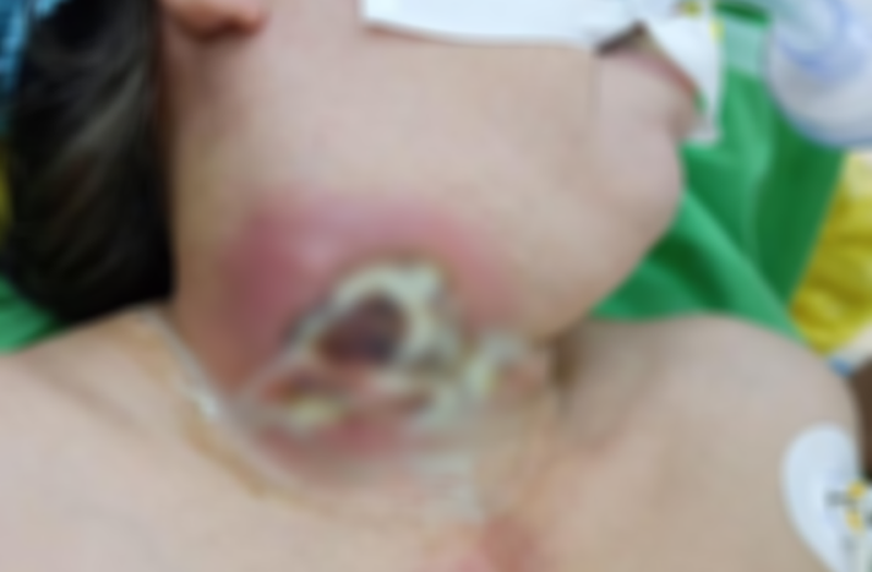 Người phụ nữ nhập viện áp xe tuyến giáp do tin tưởng thuốc nam Người phụ nữ nhập viện áp xe tuyến giáp do tin tưởng thuốc nam